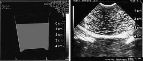 The Luci Flr Project Lung Ultrasound In The Critically Ill A Bedside