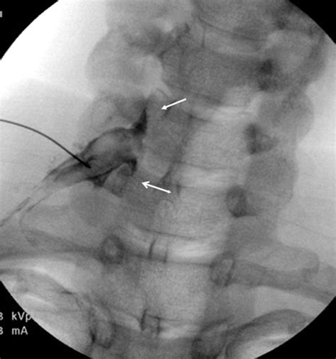 Selective Cervical Nerve Root Blockade Experience With A Safe And