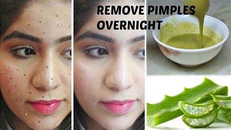 Remove Pimples Permanently 100 Results Diy Face Wash Spot