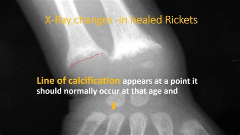 X Ray Wrist In Rickets Part 23 Rickets Pediatrics Youtube