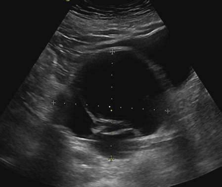 Ovarian cyst is a fairly common disease that occurs in almost 50% of all the fair sex, suffering from amenorrhea, dysmenorrhea and other menstrual irregularities. Gynaecology | 3.2 Adnexa : Case 3.2.1 Benign cystic ...