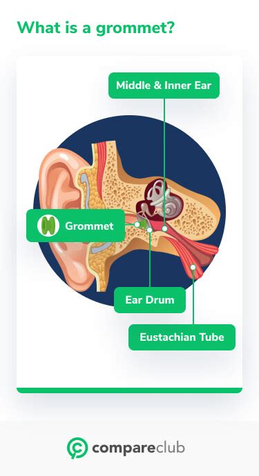 How Much Does Ear Grommet Surgery Cost In Australia