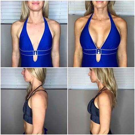 A Mom S Reason For Breast Augmentation Stacy Rody