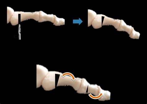 Minimally Invasive Lesser Toe Surgery David Redfern Surgery