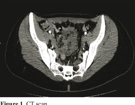 Figure 1 From Appendiceal Recurrent Colic Due To Enterobius