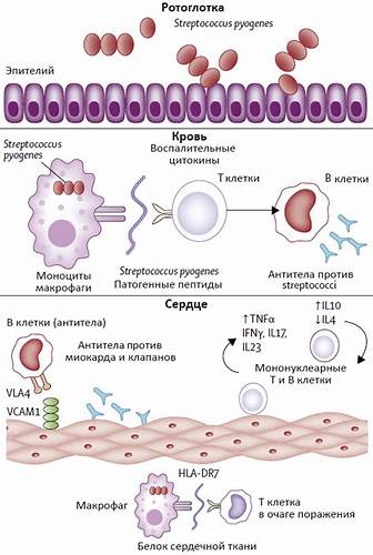 Ревматическая лихорадка Картинка - Ревматическая лихорадка