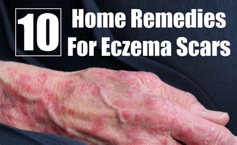 Top 10 Home Remedies For Eczema Scars Morpheme Remedies India