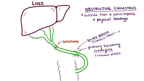 Cholestasis Liver And Gallbladder Disorders Msd Manual Consumer Version