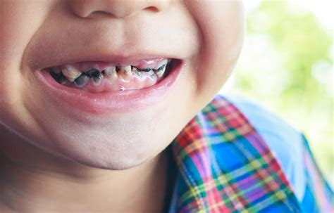 How To Avoid Kids Rotten Teeth - Tears and Hope