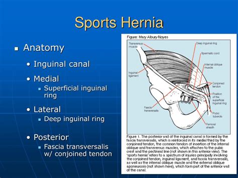 Ppt Sports Hernia Powerpoint Presentation Id339925