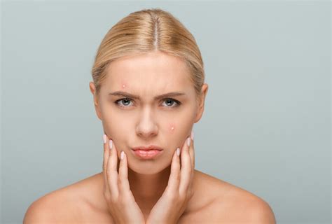Can High Levels Of Estrogen Cause Acne Emedihealth