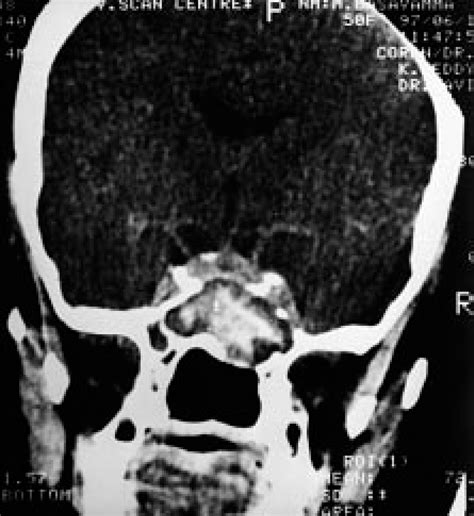 Isolated Sphenoid Lesions Diagnosis And Management Dharambir S