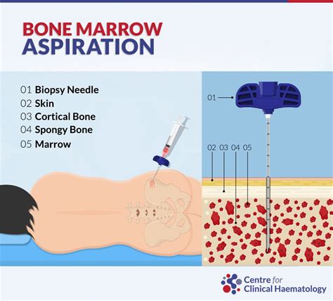 43 Bone Marrow Aspiration And Biopsy Procedure Us