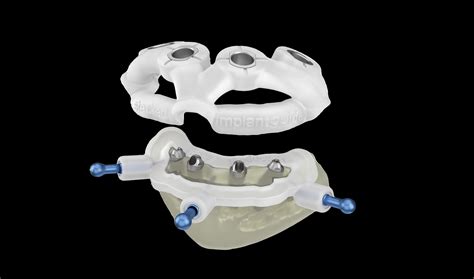 Implant Surgical Guides — Dimartino Dental Laboratory