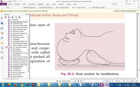 Figureshows Rose Position For Tonsillectomy Download Scientific Diagram