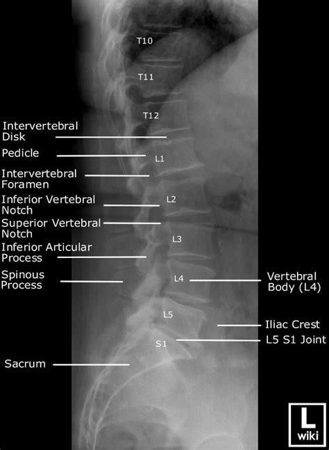 Lumbar Vertebrae Anatomy Lateral