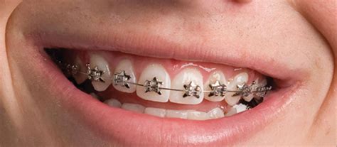 Phases Of Orthodontic Treatment Definitive Dental