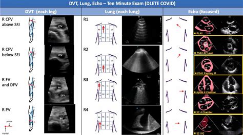 Point Of Care Ultrasound And Covid 19 Cleveland Clinic Journal Of