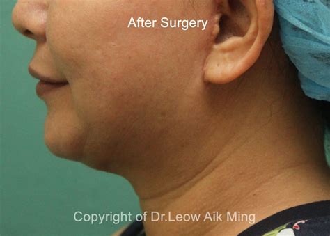 Neck Lift Elegant Plastic Surgical Centre In Ipoh And Manjung Malaysia