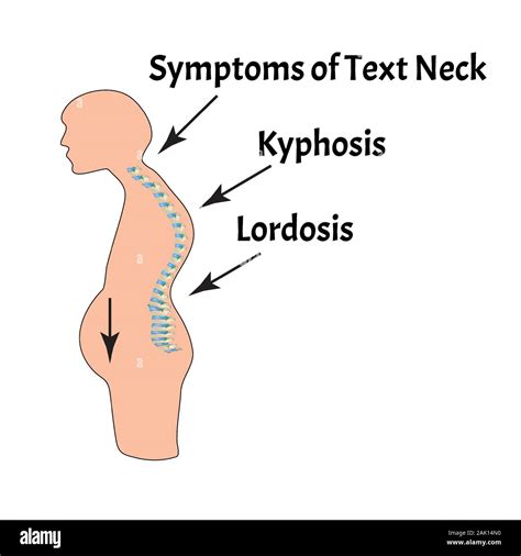 The Position Of The Spine With Lordosis Kyphosis Text Neck Syndrome