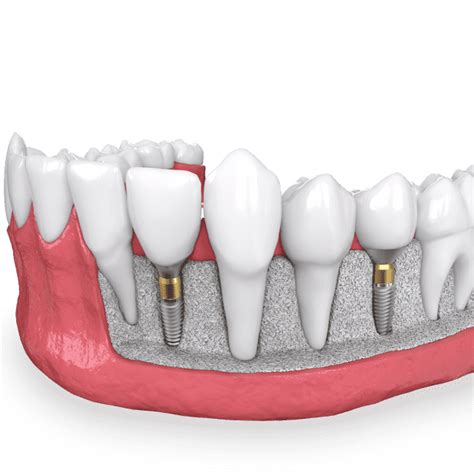 Dental Implants Newport, TN - Morristown, TN - Sevierville, TN - Implant Dentistry - Newport ...