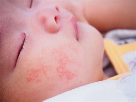 Allergic Reaction Heat Rash On Baby Face Newborn Baby Acne Milk Rash