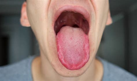 We did not find results for: Iron deficiency symptoms: Signs in your mouth you could be ...