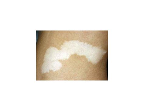 Manchas Blancas En La Piel Vitiligo Pdf Vitilio Fototerapia Vitili