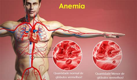 Anemia - O que é, Causas, Sintomas e Tratamentos | Dicas ...