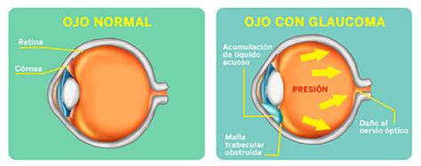 This damage is often caused by an abnormally high pressure in your eye. Día Mundial del Glaucoma | Notiexpos y Congresos