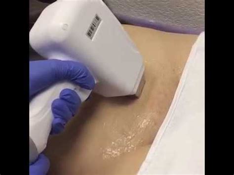 I used it once a week for only about 5 minutes until. Brazilian laser waxing review - YouTube