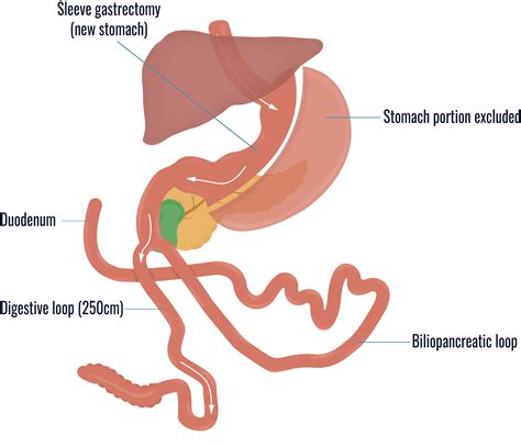 What Are Different Types Of Bariatric Surgery Dr Ceyhun Aydoğan