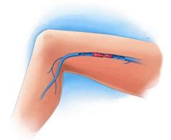 You can get them in blood vessels in just about any part you could also get a clot in the veins that carry blood back to your heart. Thrombophlebitis of the veins of the lower limb: causes, symptoms, treatment and prevention ...