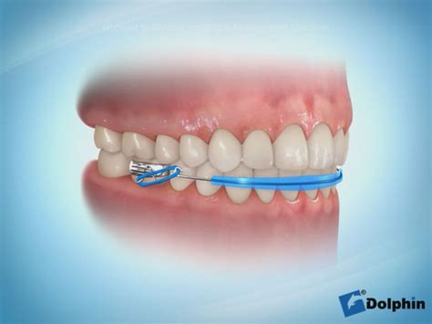 Bestseller #3 best bella lip glosses. Twin Block Appliance - DOLPHIN IMAGING