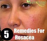 Pictures of Home Remedies For Rosacea Pimples