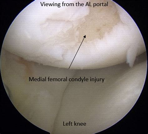 Prevention Of Medial Femoral Condyle Injury By Using A Slotted Cannula