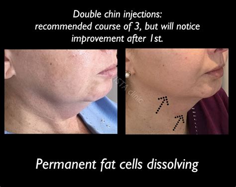 Double Chin Fat Dissolving Vista Clinic Melbourne Australia