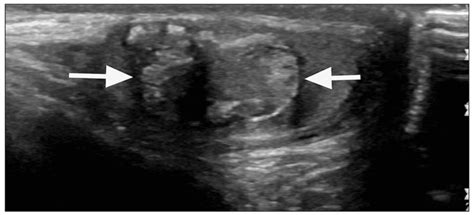 Teratoma Longitudinal Grayscale Sonogram Of The Testicle In A