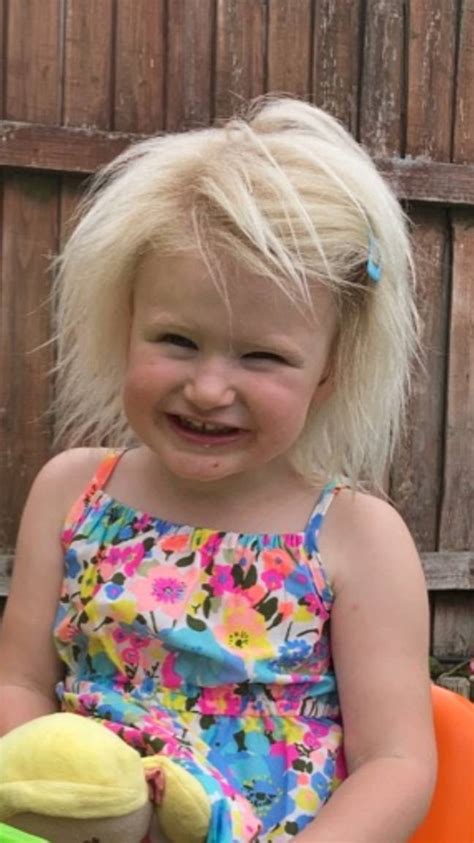 Girl With Uncomable Hair Syndrome Constantly Compared To Boris Johnson