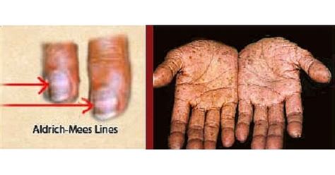 Other causes of beau's lines include trauma and exposure to cold temperatures in patients with raynaud's disease.7,8. Arsenic Poisoning - www.medicoapps.org