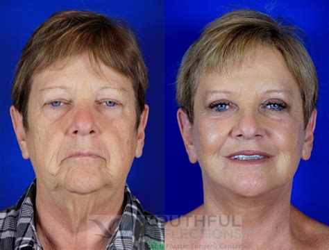 Co2 Laser Skin Resurfacing Before And After Photos Patient 2 Nashville