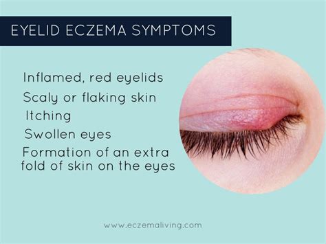 Eyelid Dermatitis How To Get Rid Of Eczema On Eyes