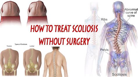 How To Treat Scoliosis Scoliosis Exercises At Home How To Treat
