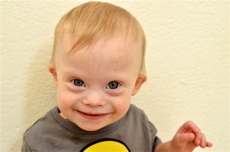 Information on down syndrome genetic disorder that results in varying degrees of physical and mental retardation and likelihood of giving birth to downs child. Down Syndrome - Speech Therapy - ENT Wellbeing Sydney
