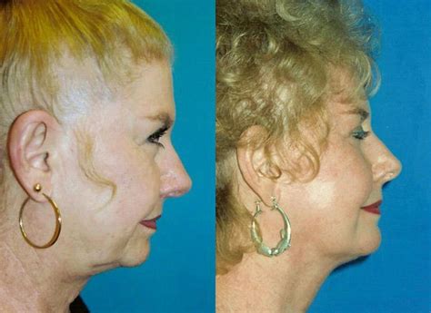 Patient 122406500 Laser Assisted Weekend Neck Lift Before And After