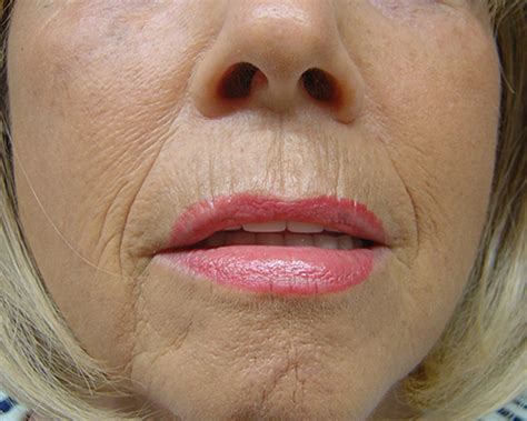 Wir wollen euch mit dieser seite antreiben und zeigen das man aus jedem körper das. Effektive Falten­behandlung mit Botox und Hyaluron­säuren ...