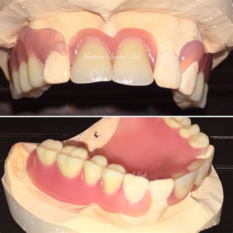 Upper Flexible Valplast Partialsfull Palate Laboratorio Dental