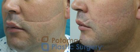 Scar Revision Before And After Photo Gallery Washington Dc Potomac