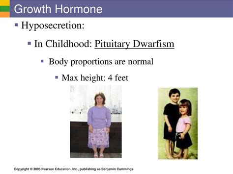 Exploring The Causes And Treatments Of Dwarfism Hyposecretion And