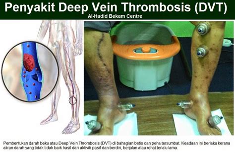 Penyakit Deep Vein Thrombosis Dvt Al Hadid Bekam Centre